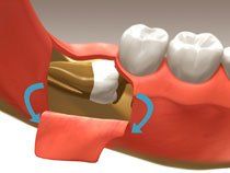 EXTRACTIONS