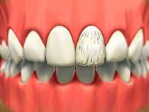 Porcelain Veneers1